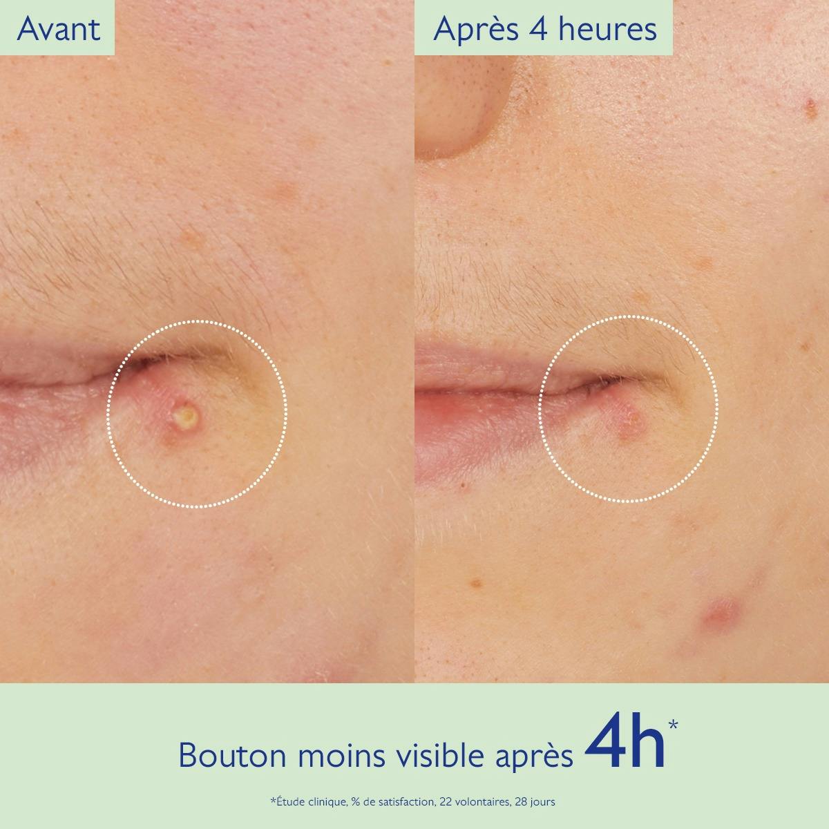 Stop Boutons Salicylique l'Acide Salicylique