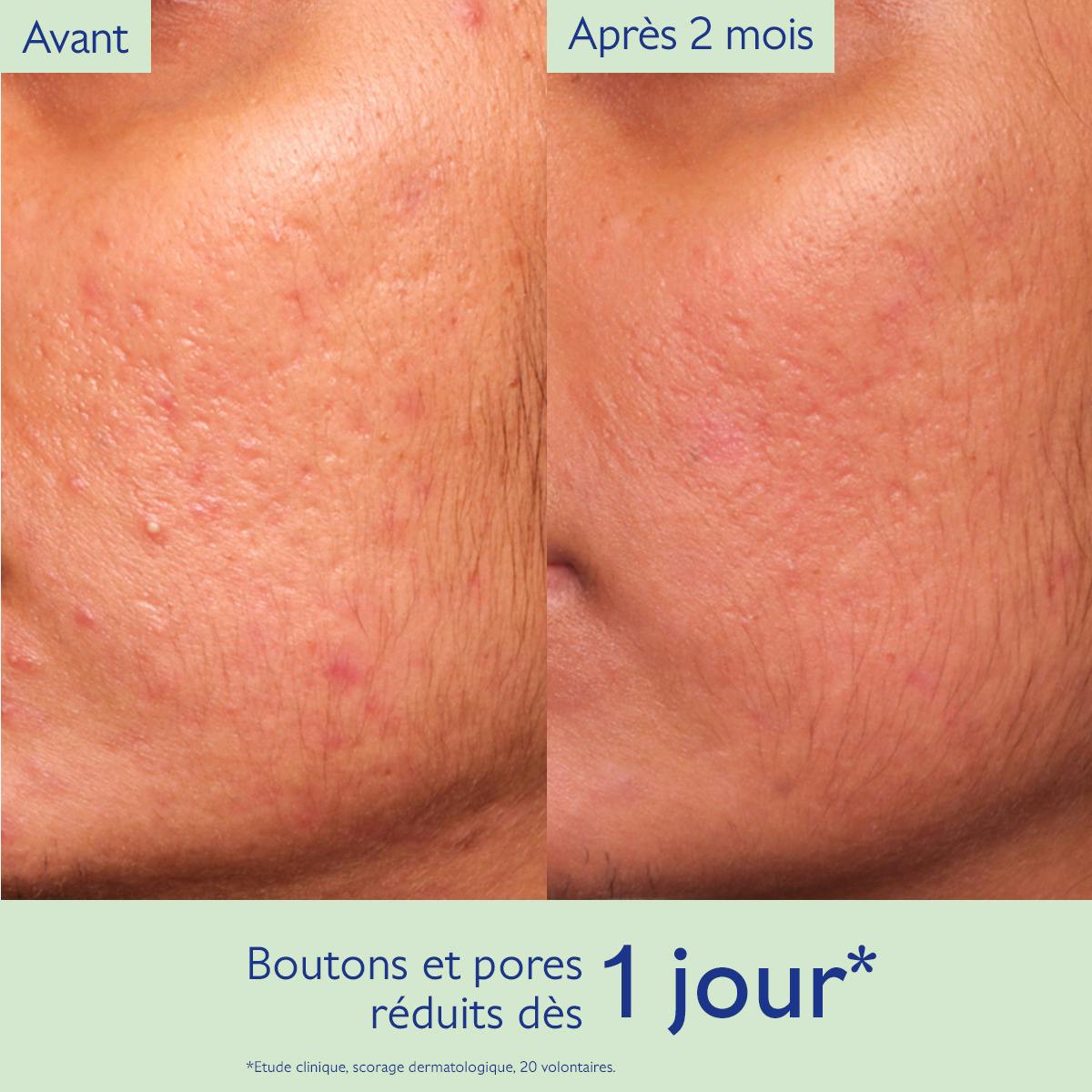 Sérum à l'Acide Salicylique Anti-imperfections