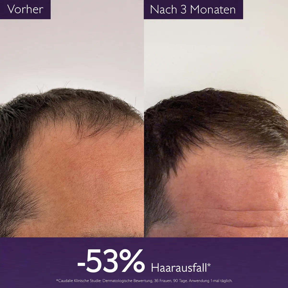 Anti-Haarausfall-Haarserum