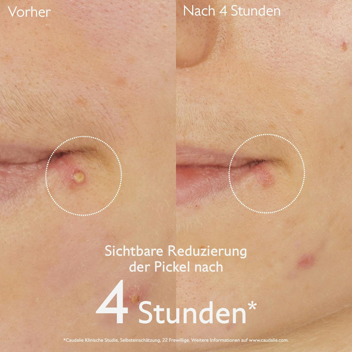 Pickel-Stopp mit Salicylsäure