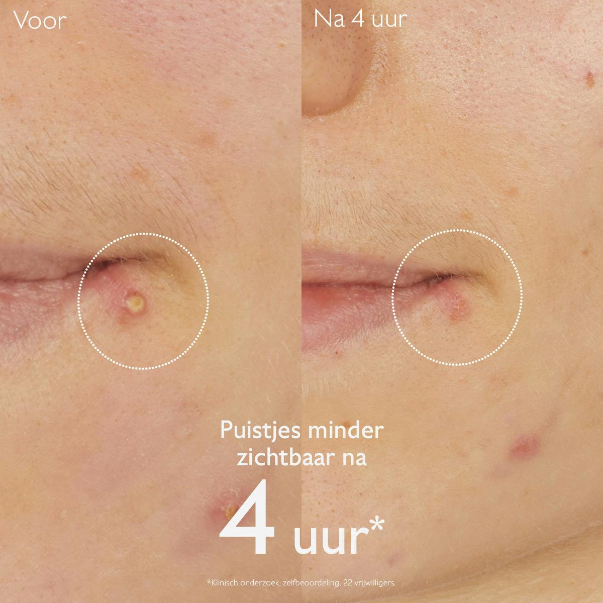 Salicylzuur Spot Treatment