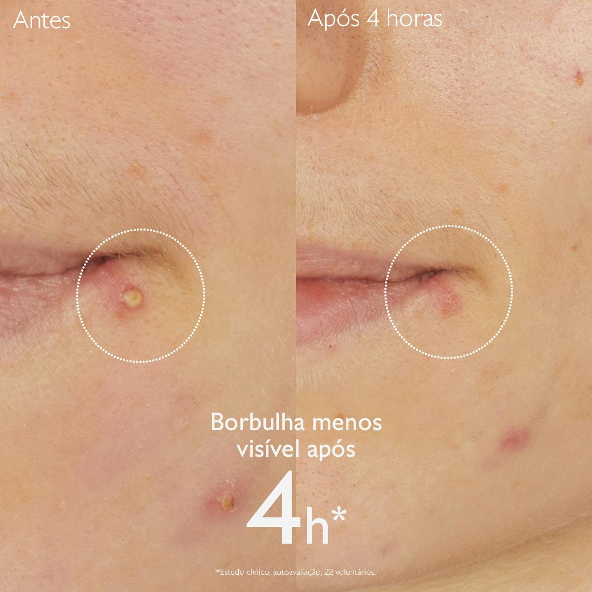 Stop Borbulhas com Acido Salicílico