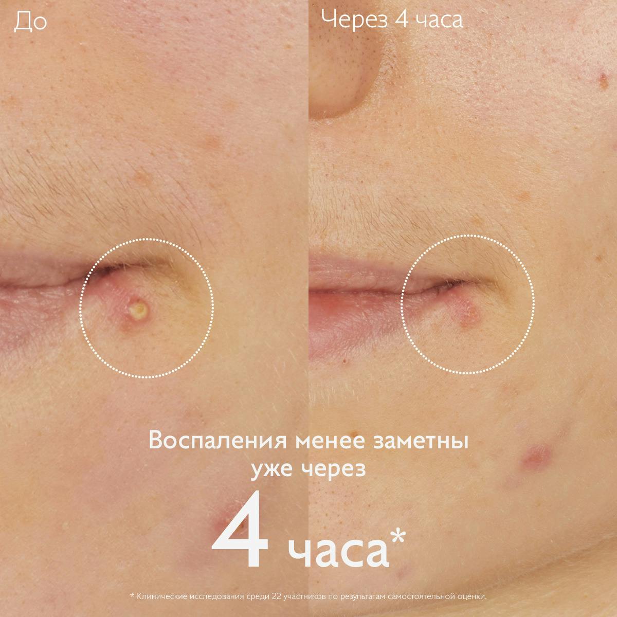 Точечное средство против несовершенств с салициловой кислотой  