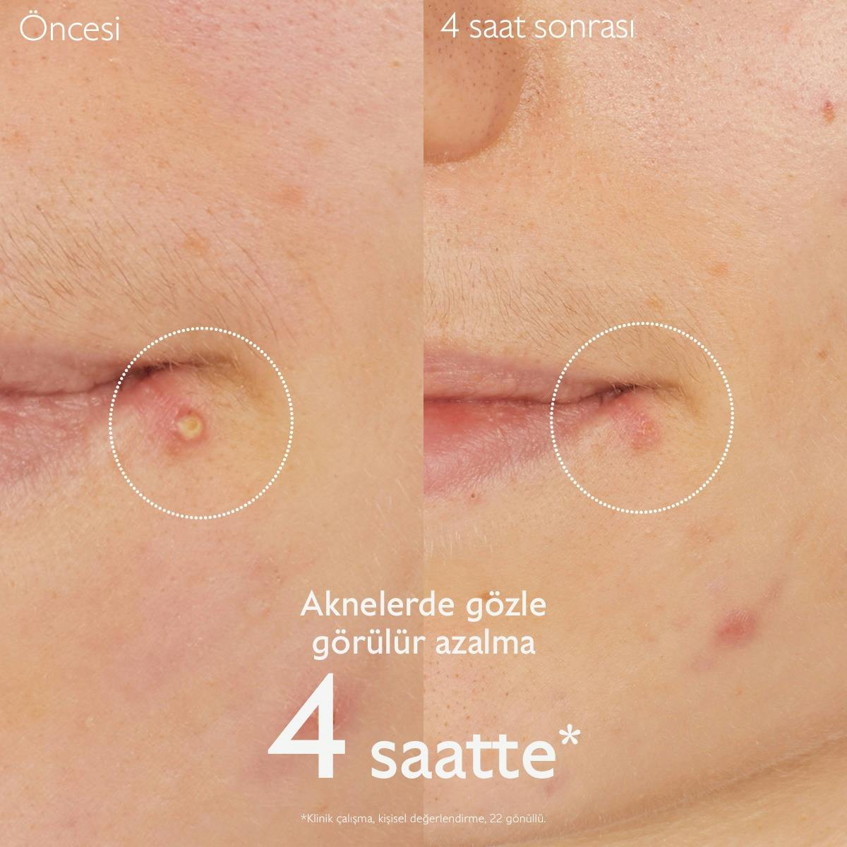 Akne Karşıtı Salisilik Spot Krem