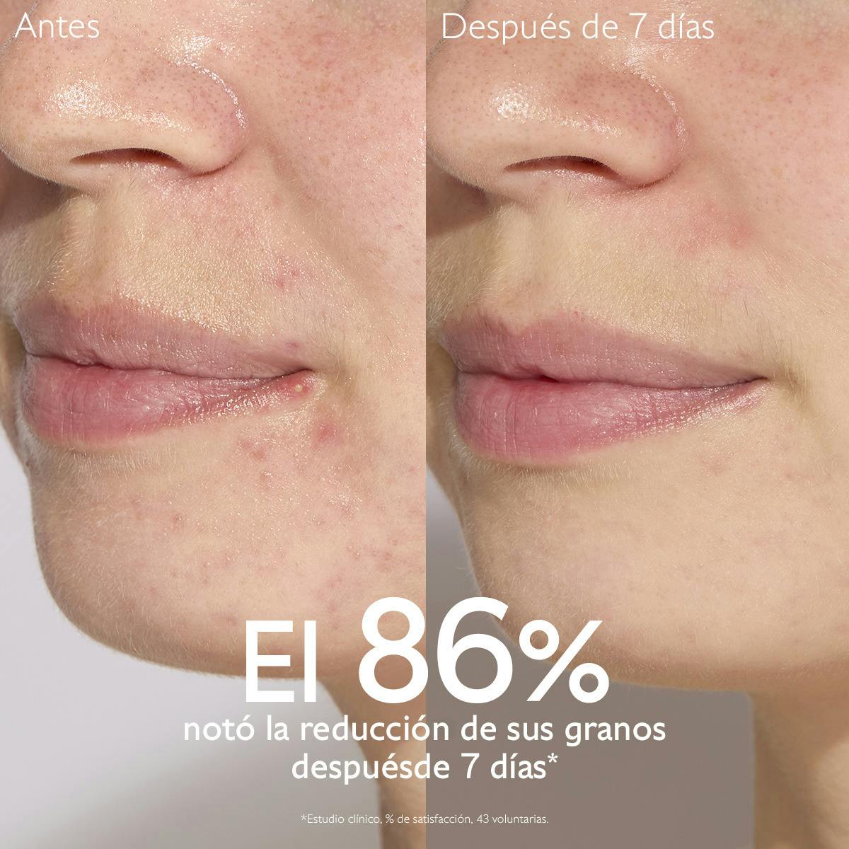 Sérum con Acido Salicílico Anti-imperfecciones