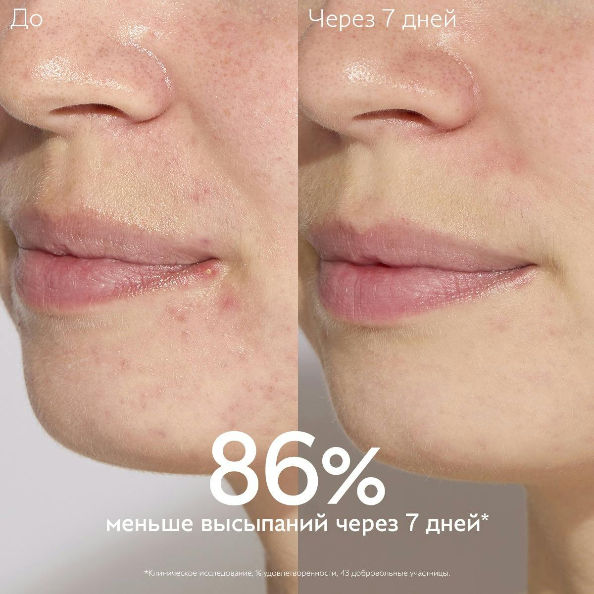 Сыворотка для проблемной кожи с салициловой кислотой