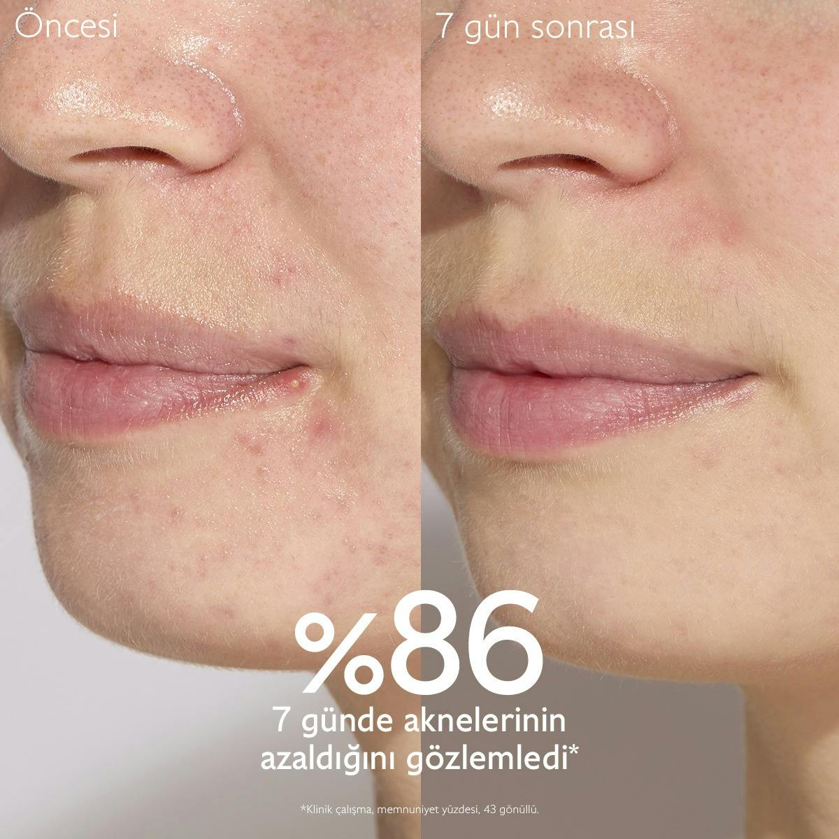 Akne Karşıtı Salisilik Serum