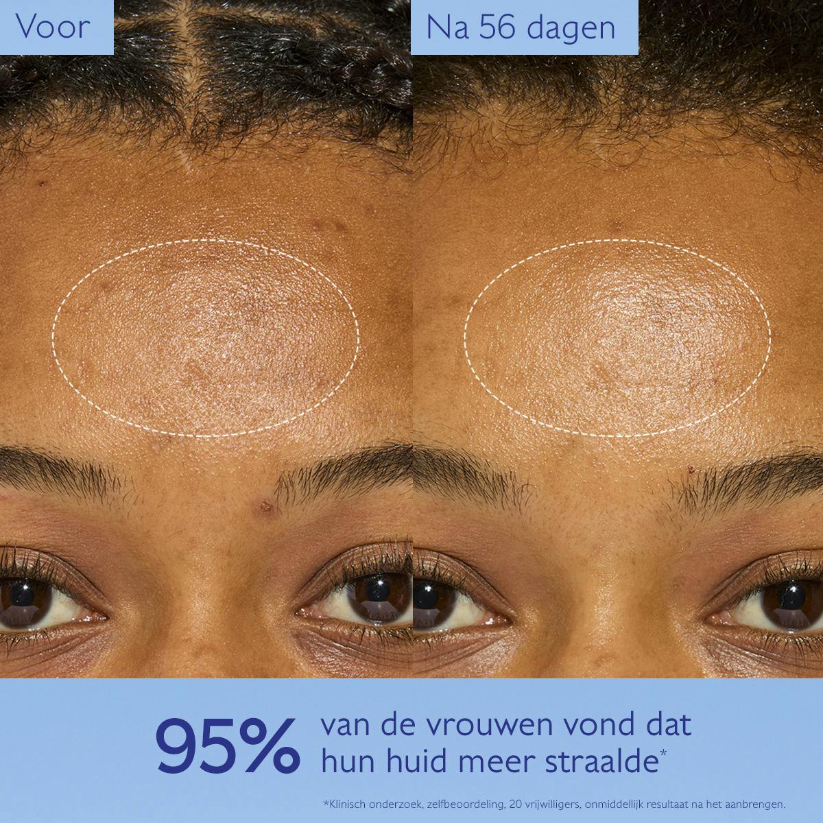 Crème met Niacinamide tegen Pigmentvlekken