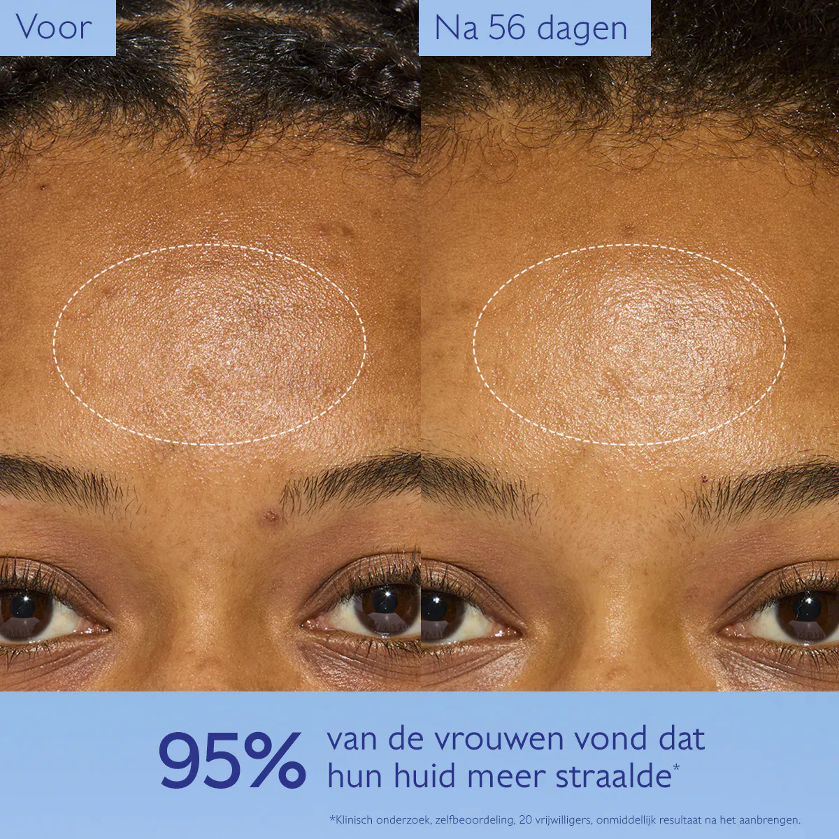 Crème met Niacinamide tegen Pigmentvlekken