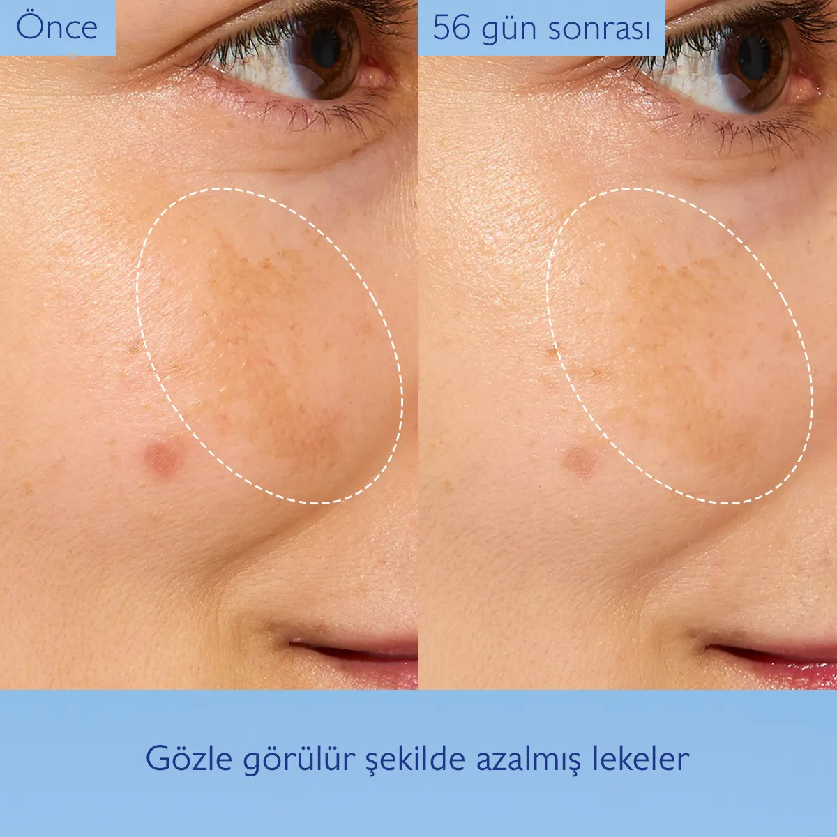 Leke Karşıtı Işıltı Verici Esans