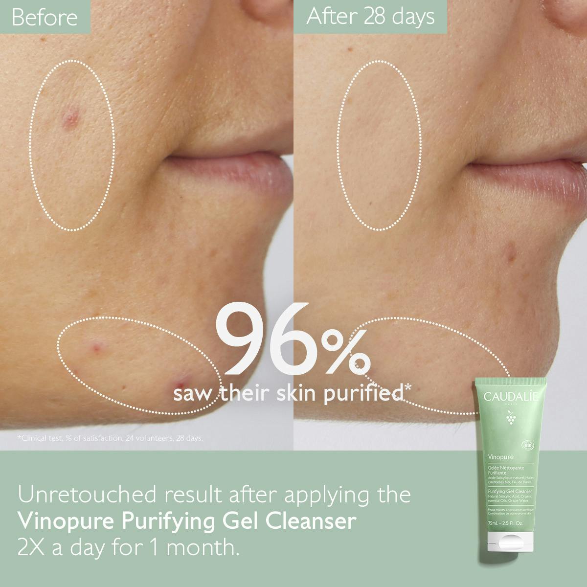 Purifying Gel Cleanser with Salicylic Acid - 75mL