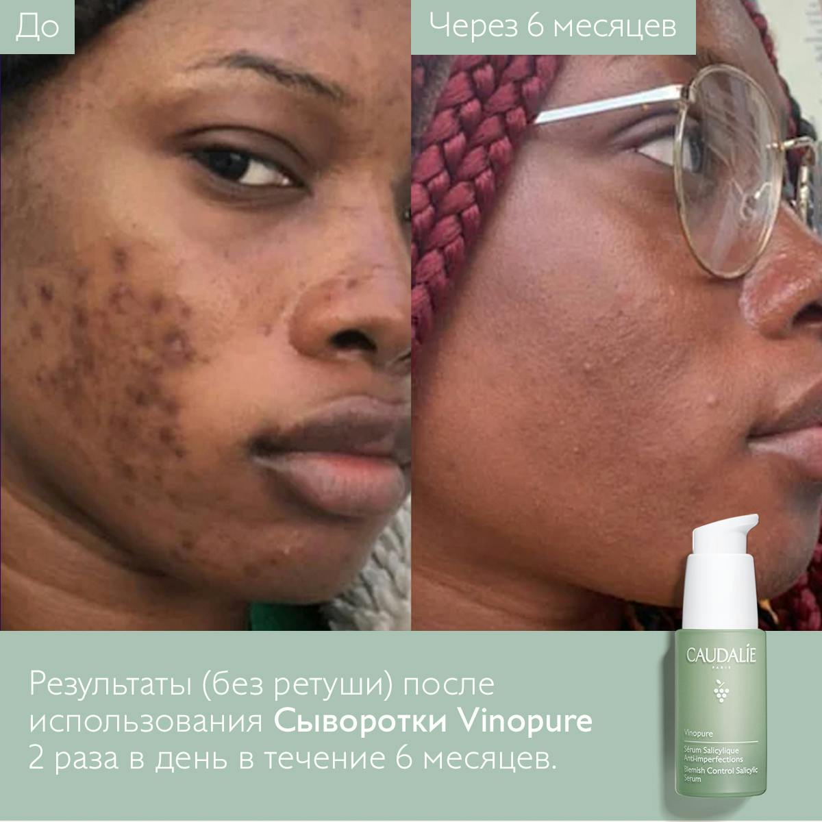 Сыворотка для проблемной кожи с салициловой кислотой