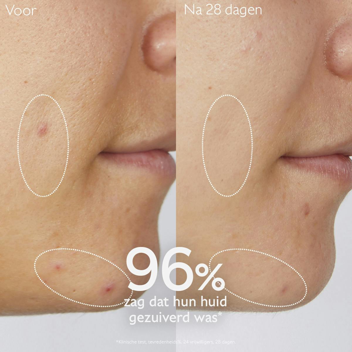 Zuiverende Reinigingsgel met Salicylzuur