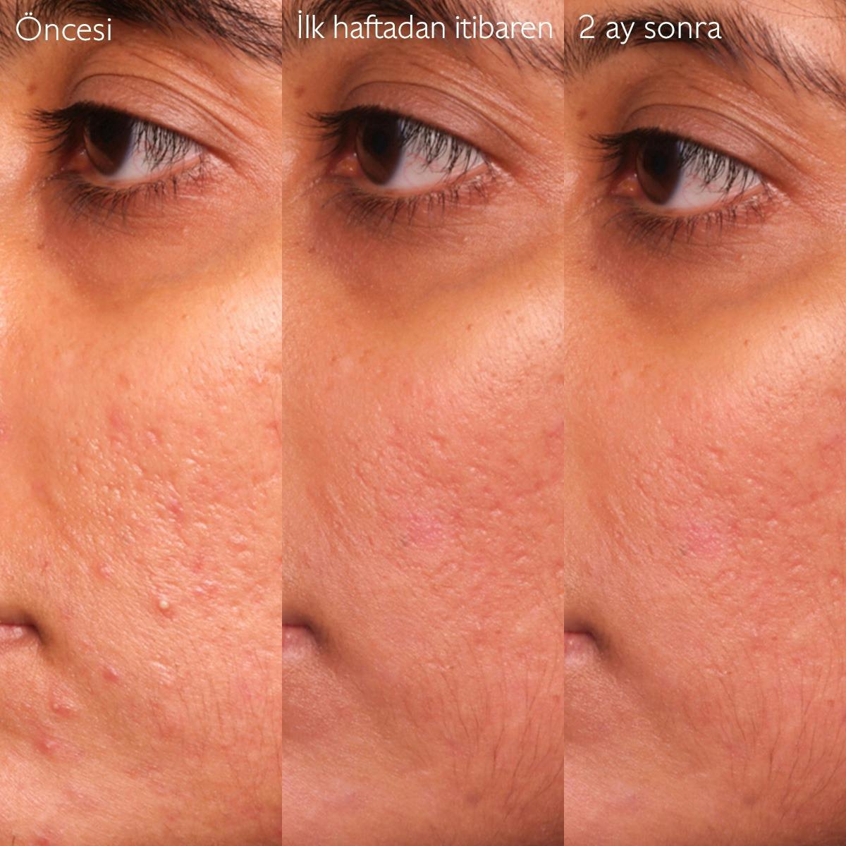 Akne Karşıtı Salisilik Serum